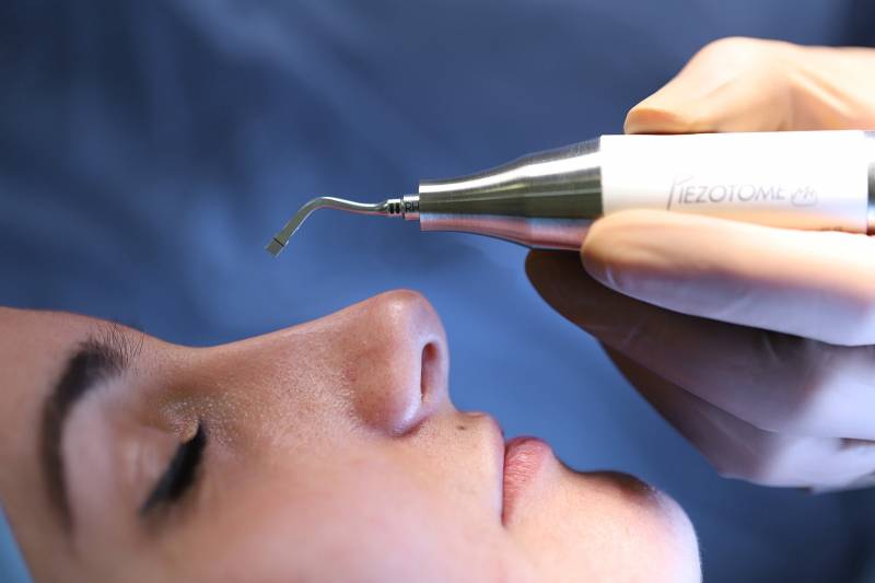 Rhinoplastie ultrasonique par le Docteur Stéphane Bruneau à Aix-en-Provence